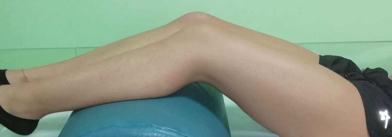 Lesione dei legamenti del ginocchio